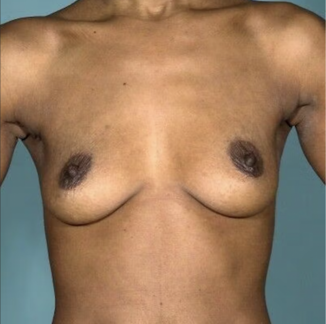 Breast Augmentation