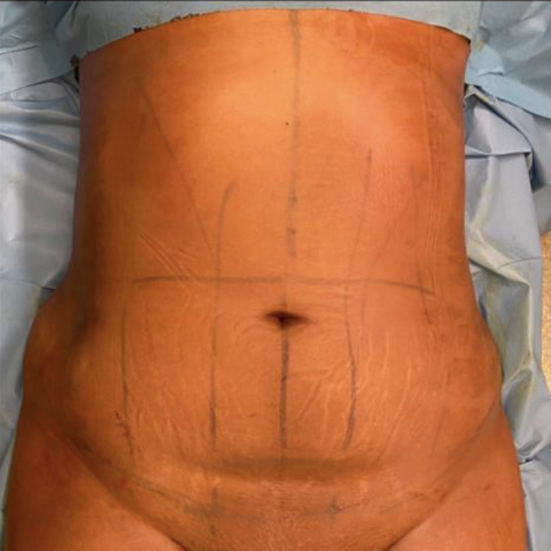 Abdominoplastia