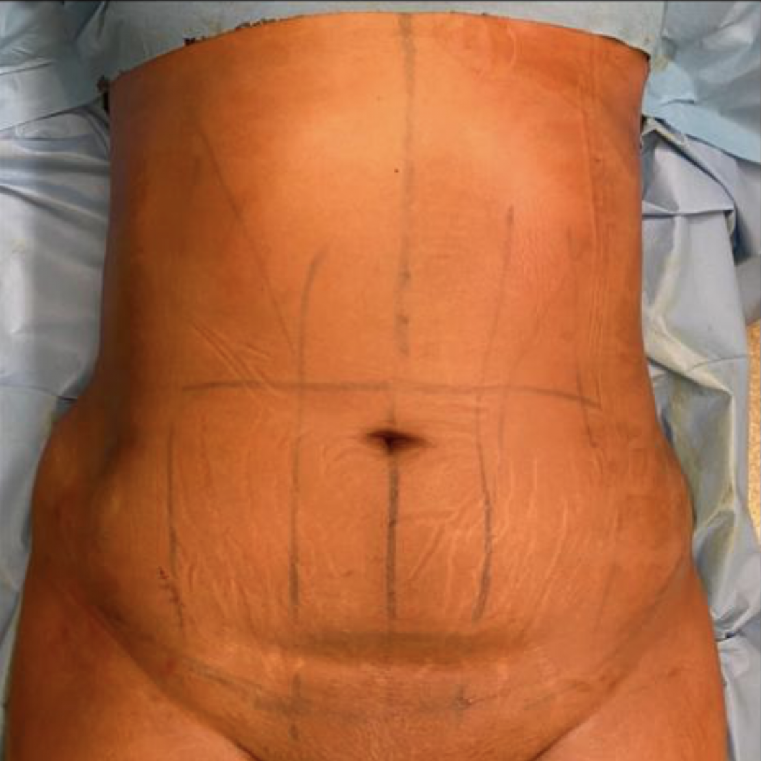 Tummy Tuck 