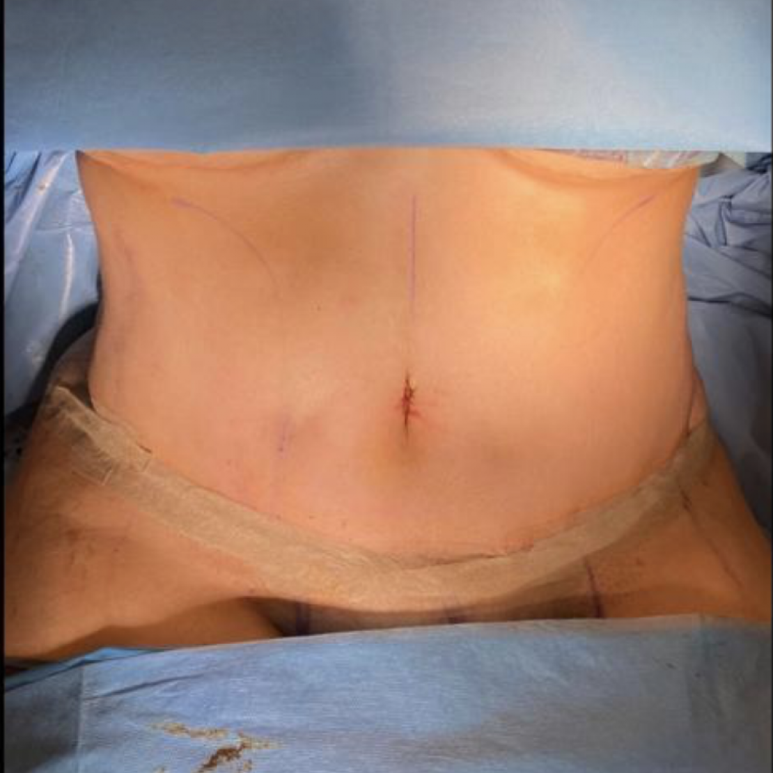 Abdominoplastia