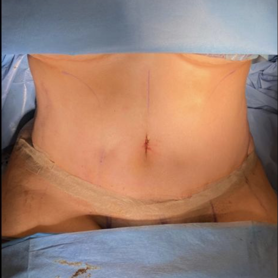 Tummy Tuck 