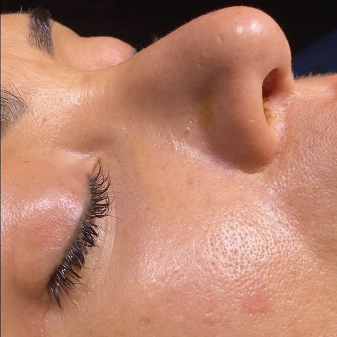 Rinoplastia