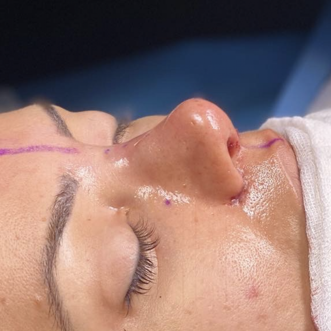 Rinoplastia