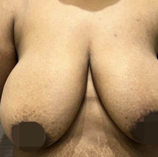 Breast Lift