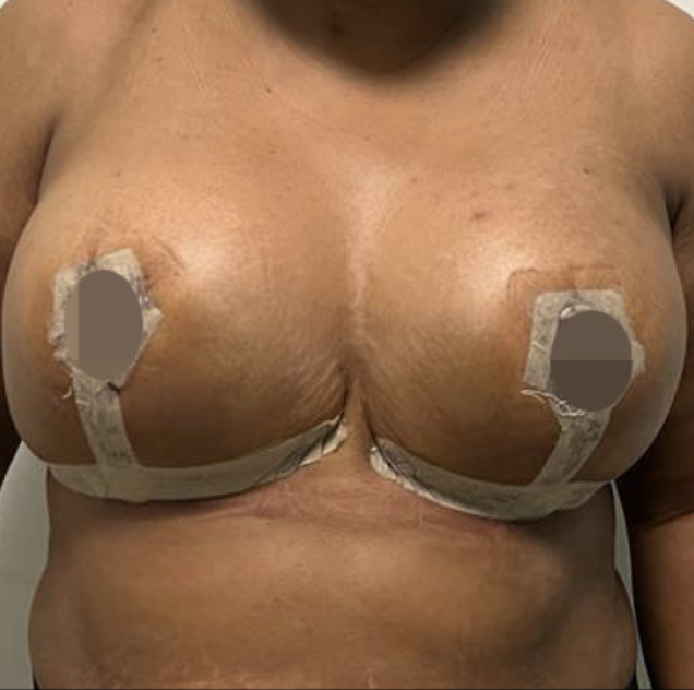 Breast Lift