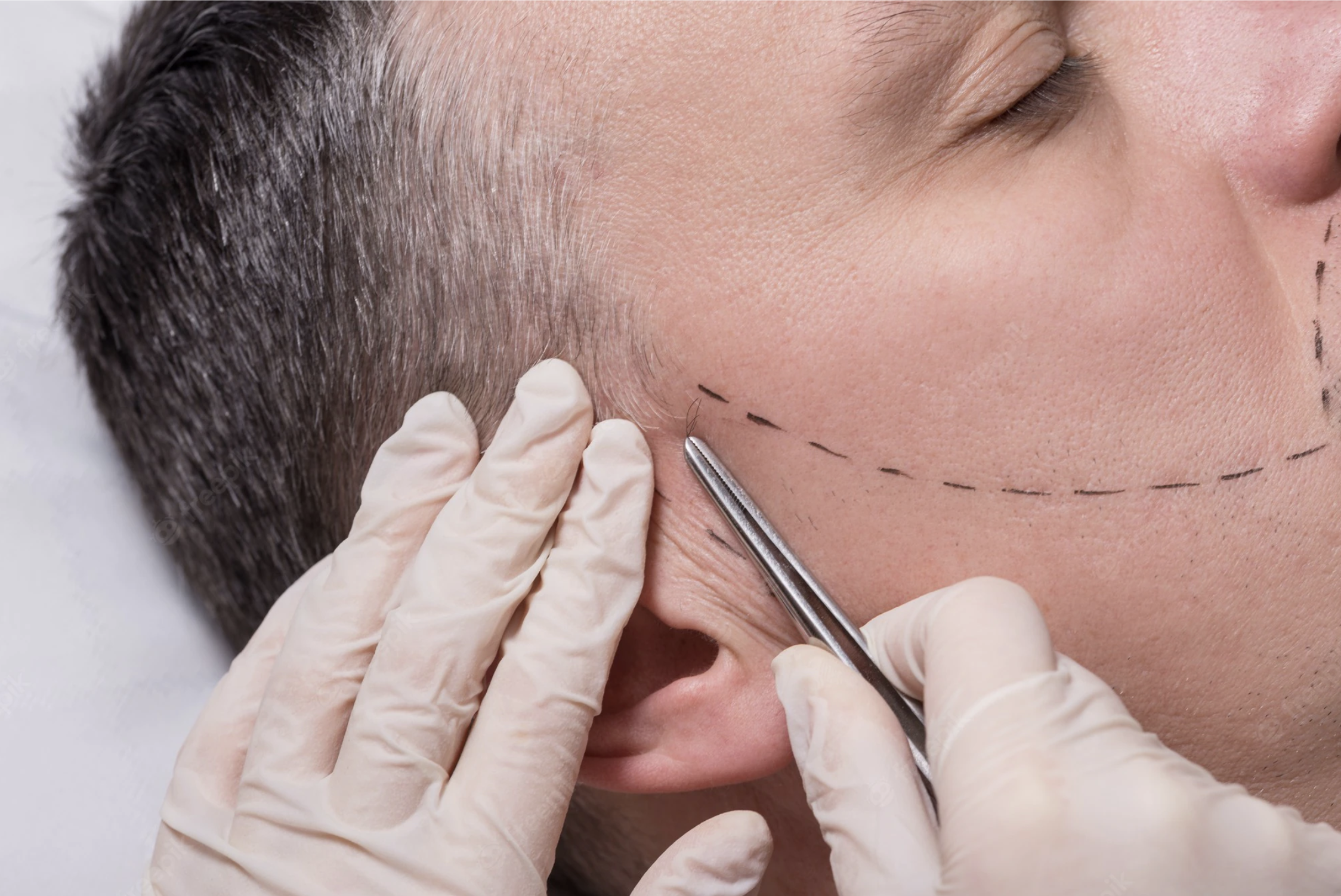 What are the Advantages of Sapphire Hair Transplantation?
