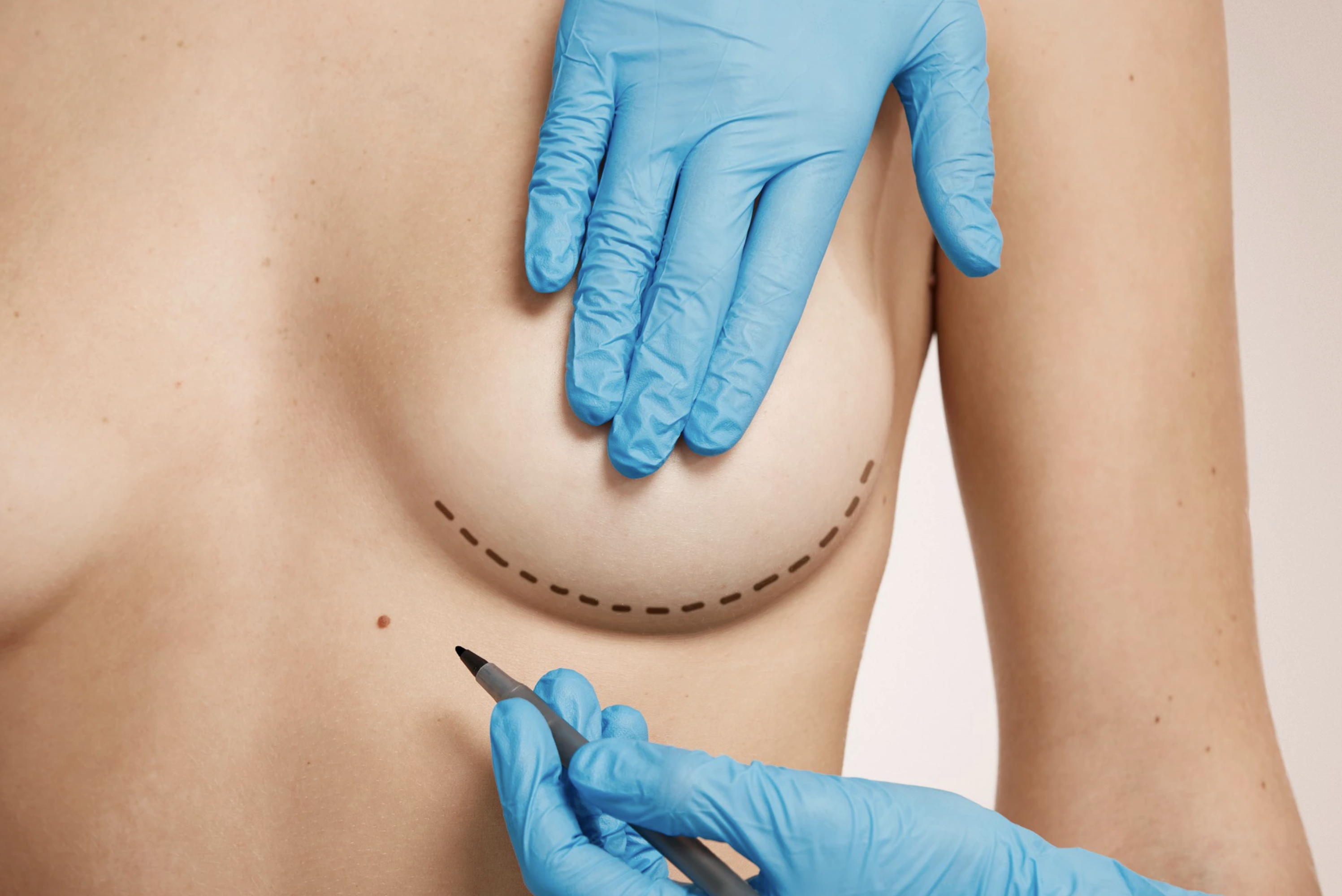 What Is The Recovery Time For Breast Augmentation Surgery?