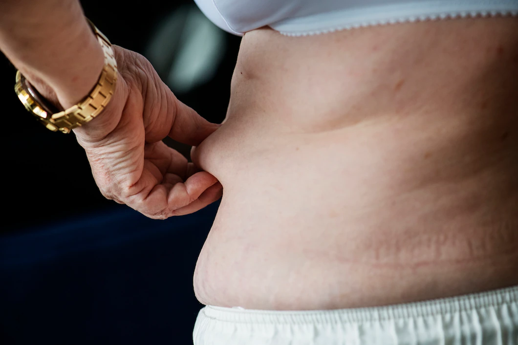 What Is Sleeve Gastrectomy ?