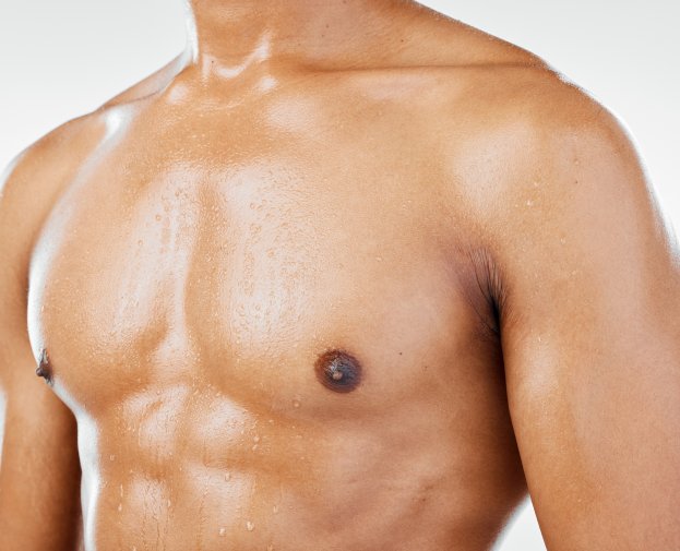 Gynecomastia