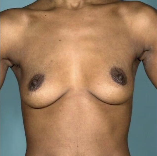 Breast Augmentation TR